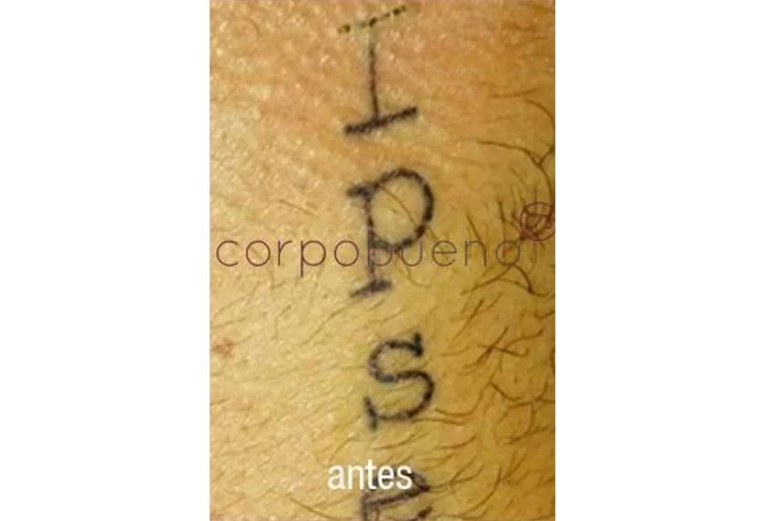 Remoção de Tatuagem - antes