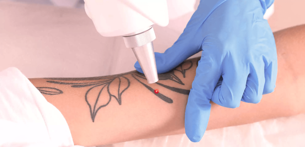 Tratamento Remoção de Tatuagem