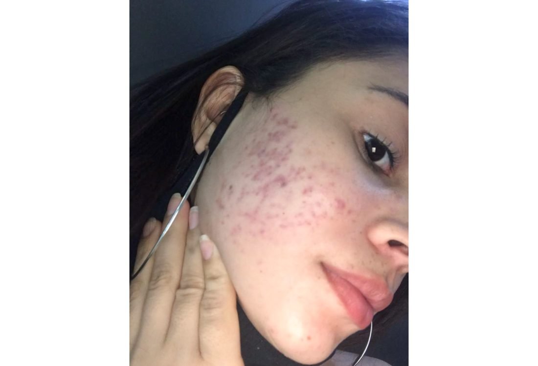 Cicatrizes e Acnes - depois