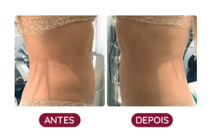 Antes e Depois