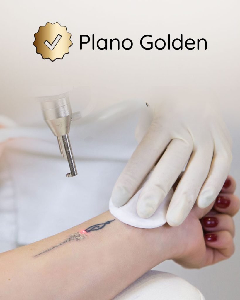 Plano Golden Remoção de Tatuagem