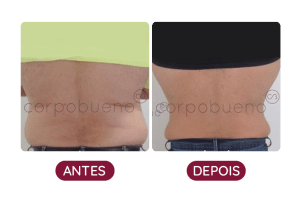 Antes e Depois