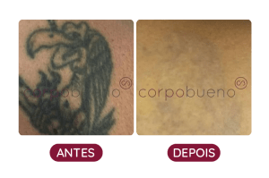 ANTES E DEPOIS