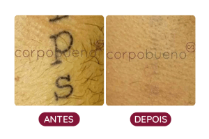 Antes e Depois