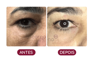 Antes e Depois