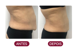Antes e Depois