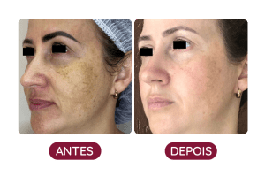 Antes e Depois