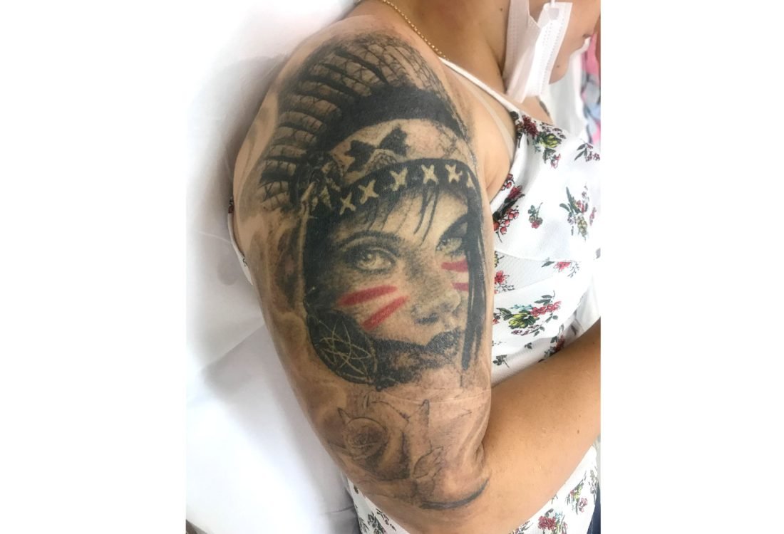 Tatuagem Remoção - antes