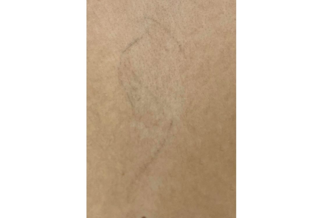 Tatuagem Remoção - Renove a sua pele - depois