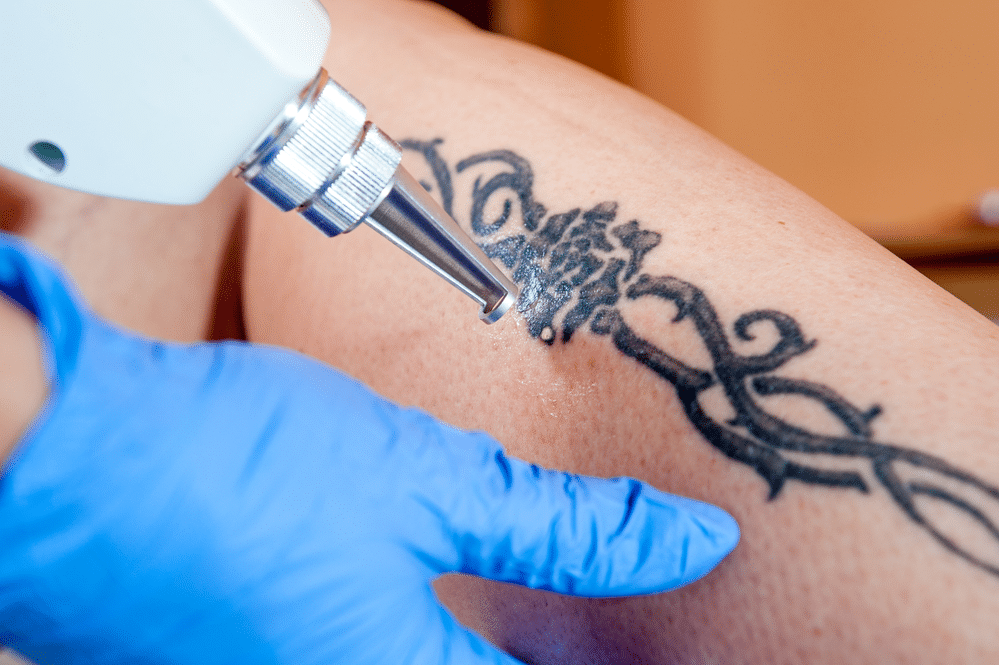 Remoção de tatuagens em Campinas