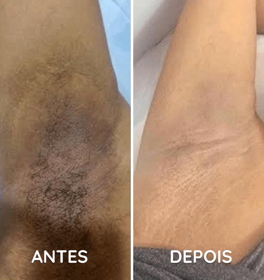 Depilacao A Laser Antes E Depois Antes E Depois Do Tratamento Com